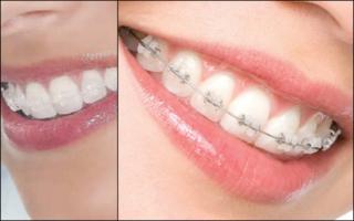 GOE - Ortodontia no Santo Agostinho - BH - Implantes Dentrios e Prteses  no Santo Agostinho - BH